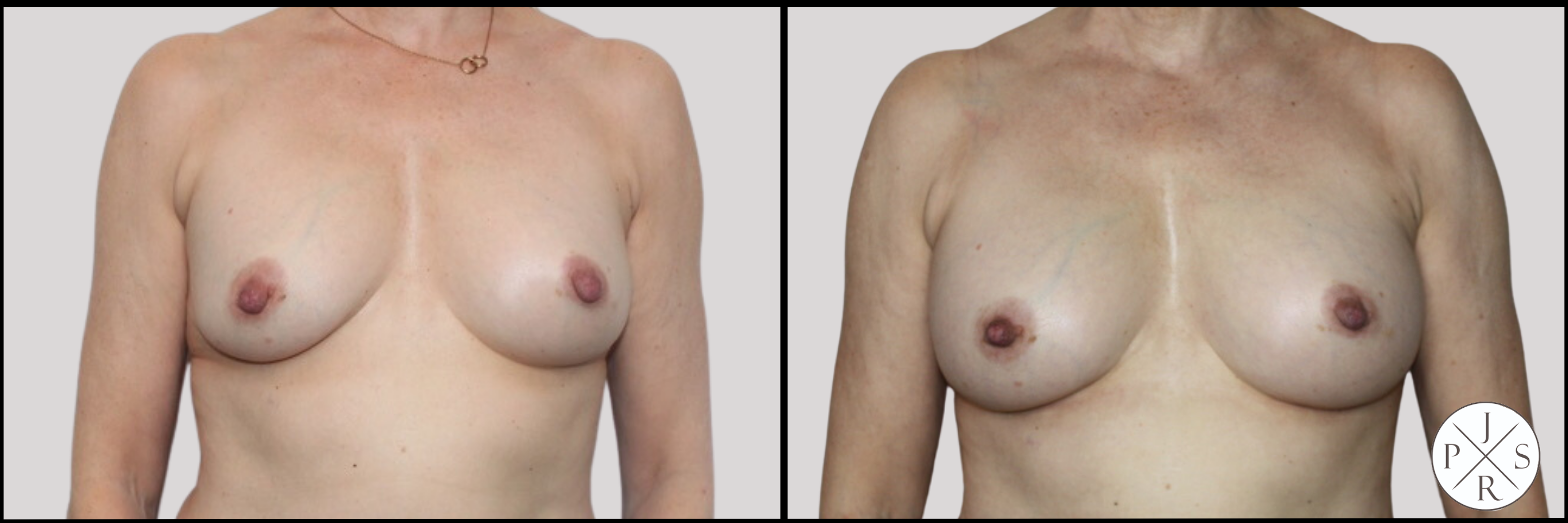 Breast Revision Before & After Image